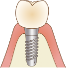 インプラント