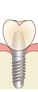 インプラント