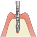 歯根部を埋入